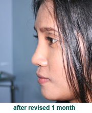 plastic_surgery_augmentation_rhinoplasty